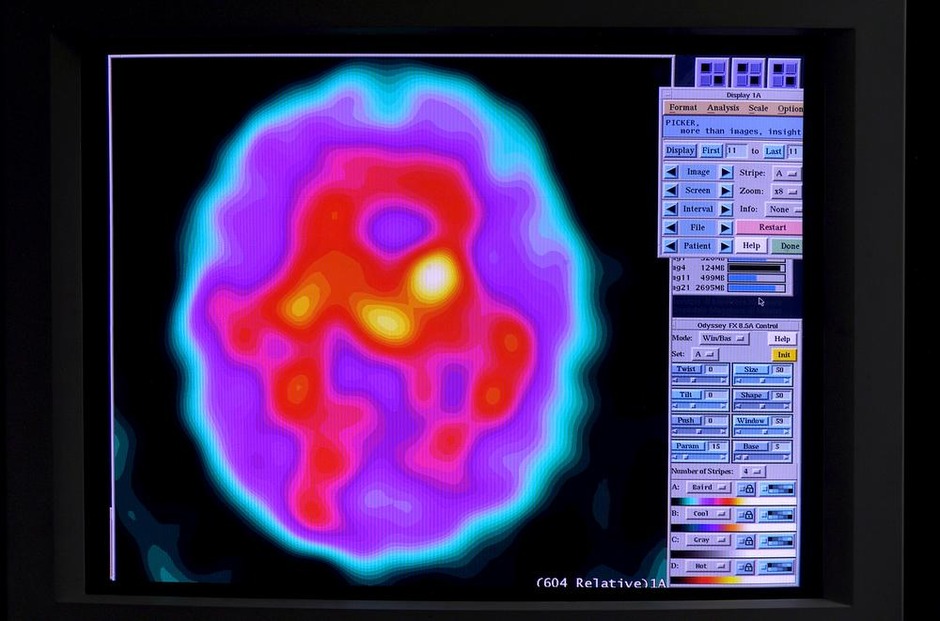 Le scanner cérébral améliore grandement le diagnostic précoce de l'Alzheimer